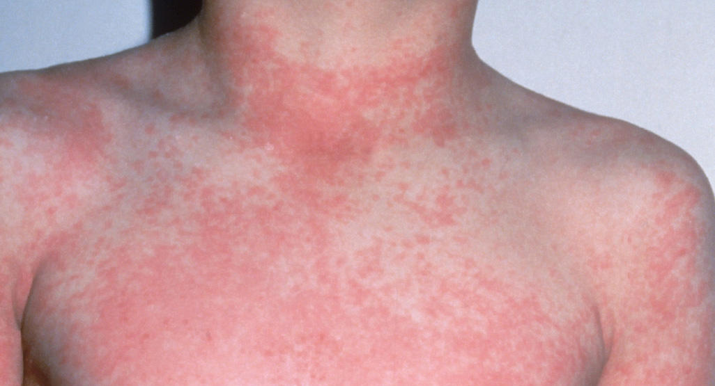 Mehr Scharlach-Fälle in Deutschland wie im gesamten letzten Jahr