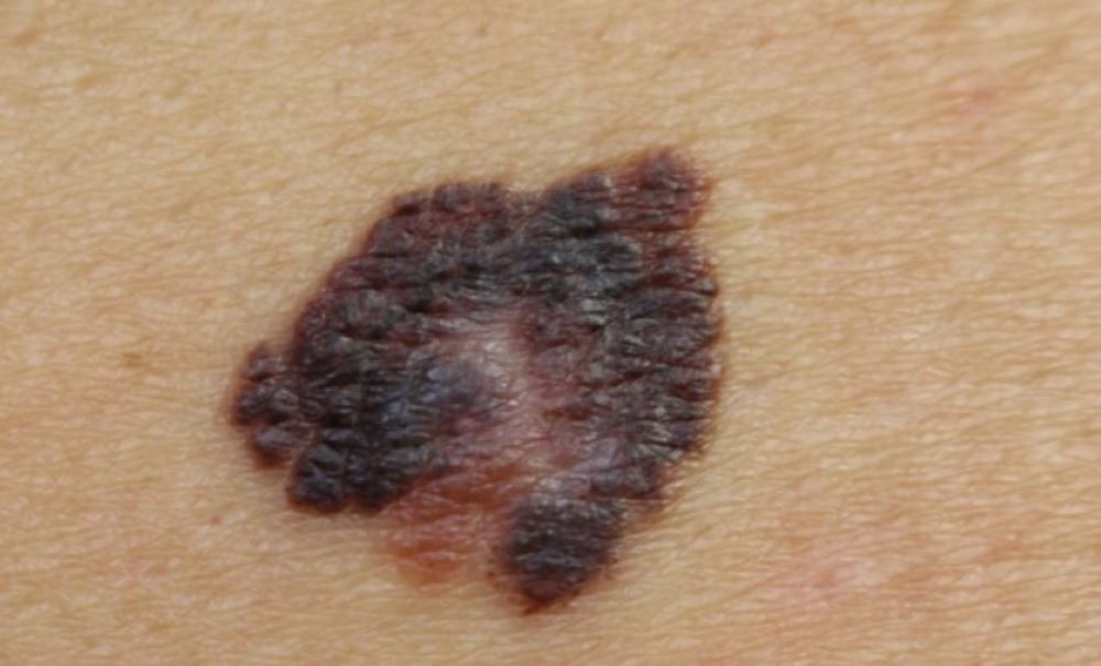 Laut Krankenkasse geht nur ein Drittel zur Hautkrebsvorsorge