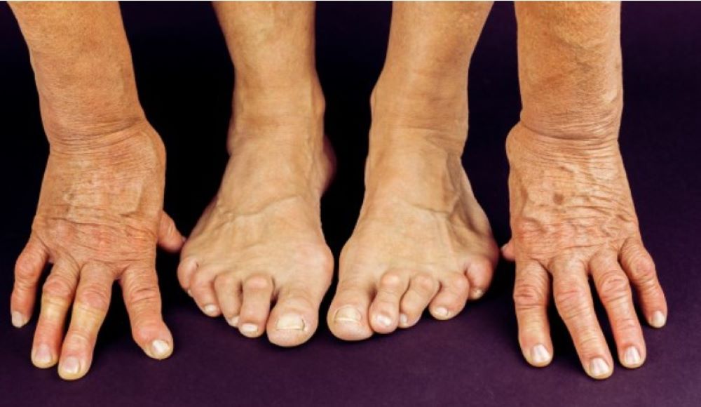 Geringe Cortison-Mengen haben einer Studie zufolge auf den Blutdruck und das Gewicht von Rheuma-Patienten