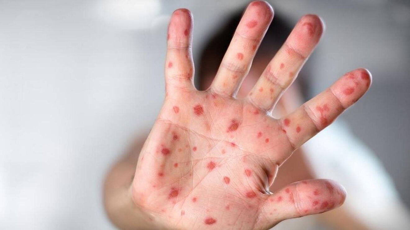 Mpox: WHO warnt vor Ausbreitung neuer Linie