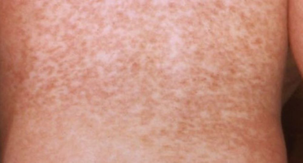 Britische Gesundheitsbehörden fordert Millionen Menschen auf sich gegen Masern impfen zu lassen